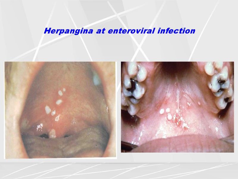 Herpangina at enteroviral infection